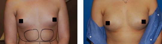 fat-transfer-breast-augmentation